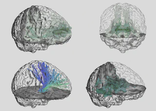 Four renderings of a grayscale brain, each with a transparent part and an opaque part. Each brain has colorful medical data: three of them have colorful blobs, but the bottom left has likes that look like spaghetti.