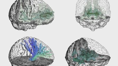 Tractography in Context: Multimodal Visualization of Probabilistic Tractograms in Anatomical Context featured image